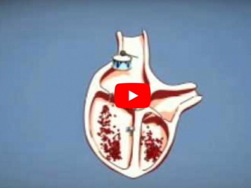 AED相關 | 心臟跳動與AED除顫(動畫)